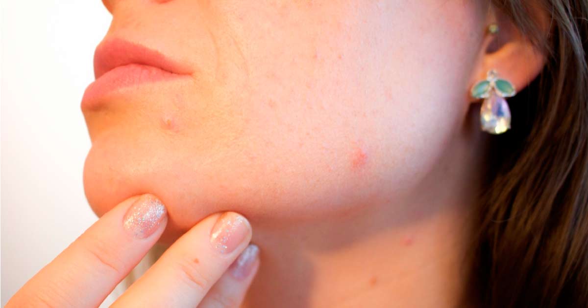 beta hidroxicidos en la rutina de skincare